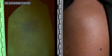 Forensic Nurse in Virginia Develops Technology to Detect Bruises on Dark Skin – NBC4 Washington